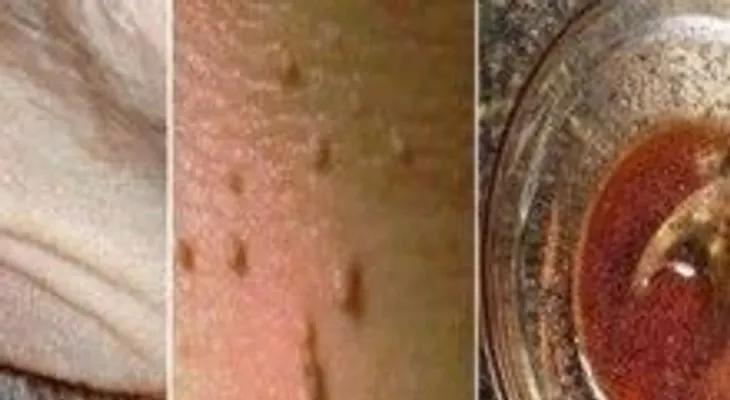 Destruye a tus lunares, verrugas, espinillas y manchas de edad