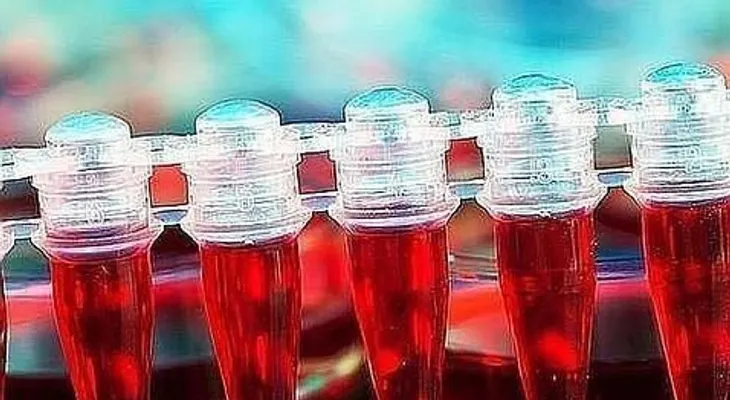 Una terapia celular controla un mieloma múltiple resistente a todos los tratamientos
