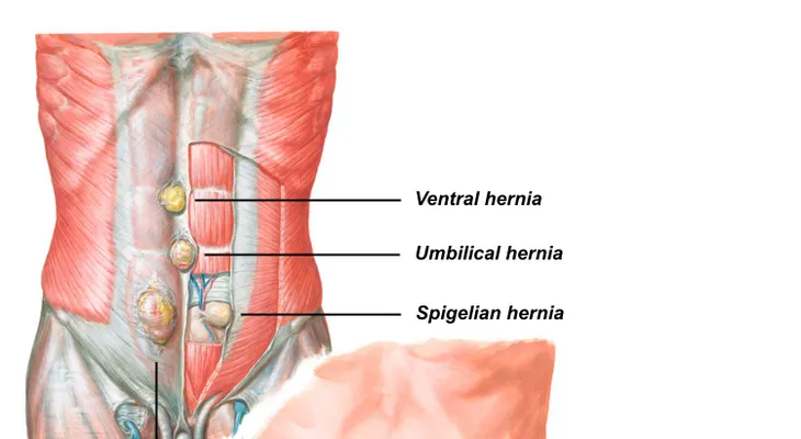 Remedios caseros para hernia umbilical