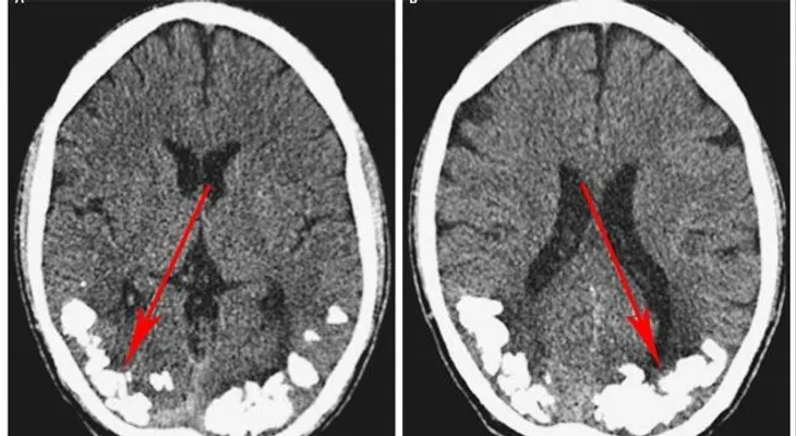 Descubren joven de 24 años, tenía piedras en el cerebro por más de 10 años; sufría de fuertes dolores de cabeza