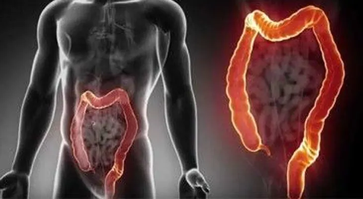 Las alteraciones en el ritmo intestinal pueden ser síntomas de cáncer de colon 
