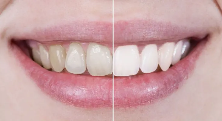 Ocho alimentos que dañan los dientes