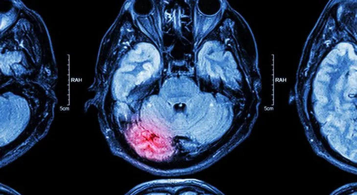 Mujer estaba gestando un bebé en el cerebro