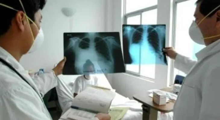  OMS plantea formula para reducir en 90 por ciento muertes por tuberculosis 