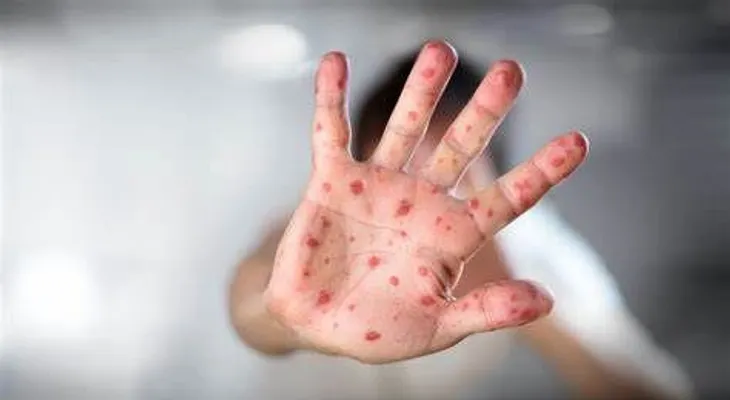 La viruela del mono se produce por contacto con animales; comienza con fiebre, dolor de cabeza y agotamiento