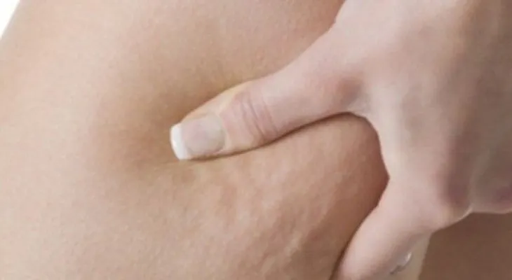 3 infusiones muy efectivas para combatir la celulitis