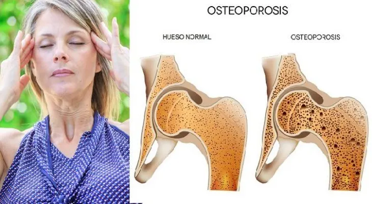 Nutrientes que necesitas para tratar la osteoporosis y el vértigo