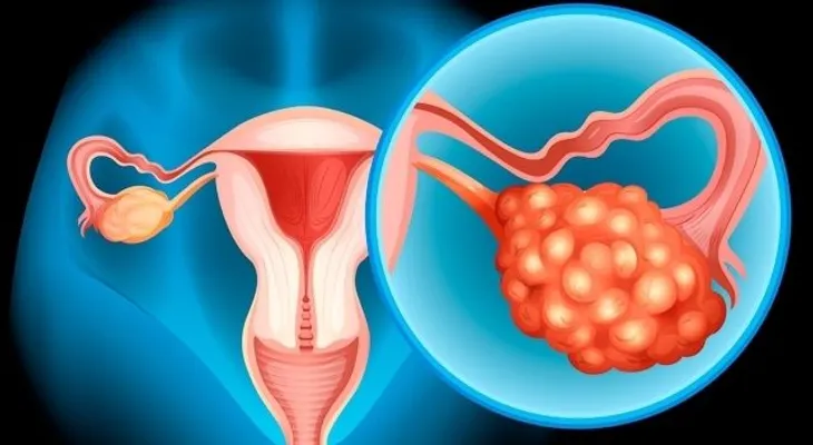 Cómo tratar la inflamación en los ovarios