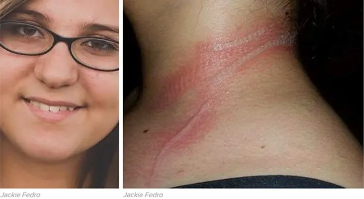 Una adolescente sufre quemaduras por usar el móvil mientras se cargaba la batería.