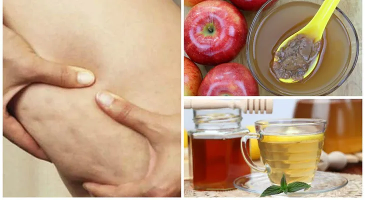El milagroso vinagre de manzana para quitar la celulitis 