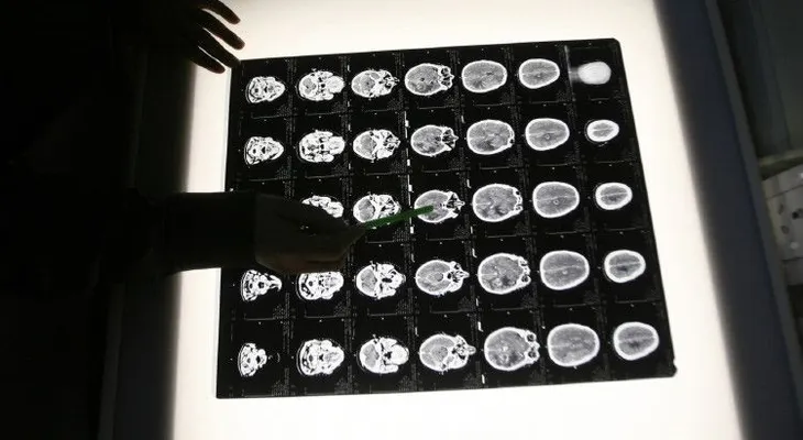Un modelo matemático predice el desarrollo de los tumores cancerosos