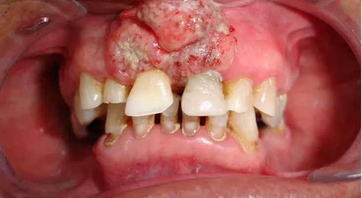 Confirman que el sexo oral provoca cáncer bucal
