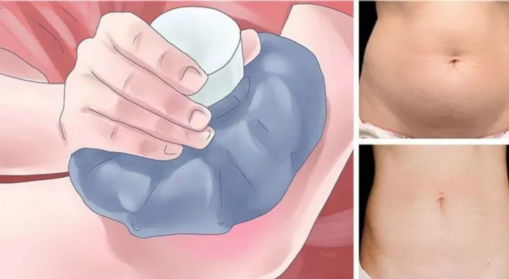 La terapia con hielo para quemar grasa: ¡Los Resultados son increíblemente muy rápidos!