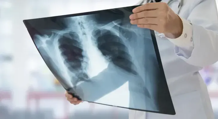 Las muertes globales por tuberculosis subieron por primera vez en una década