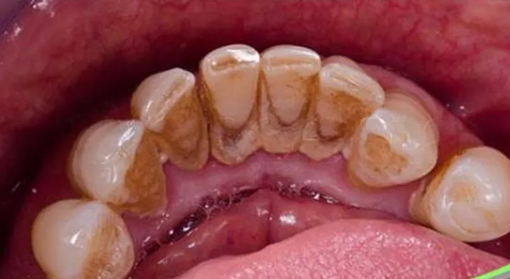 Truco para la placa dental!!!
