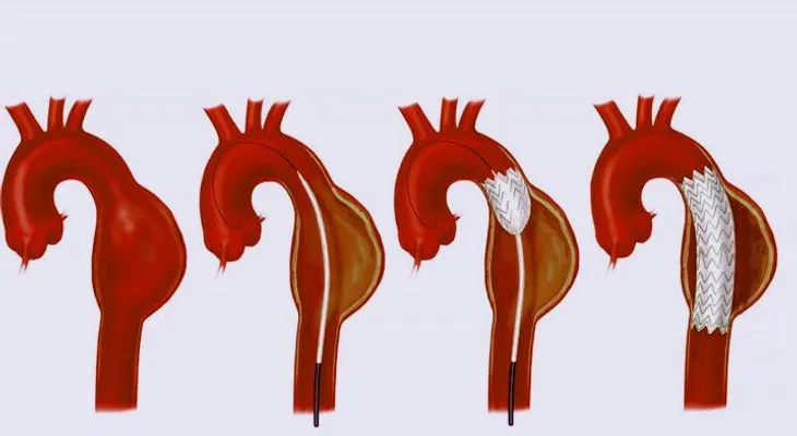 El aneurisma como producto del tabaquismo y cómo prevenirlo