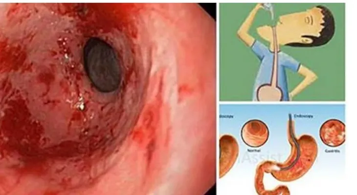 Elimina la acidez y la gastritis para SIEMPRE