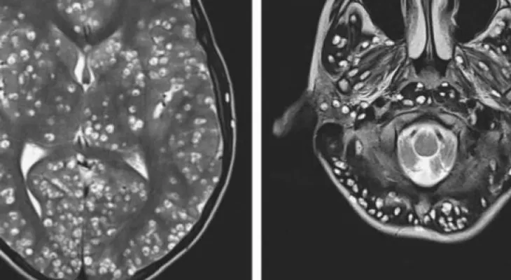 La impactante historia del paciente cuyo cerebro estaba lleno de parásitos