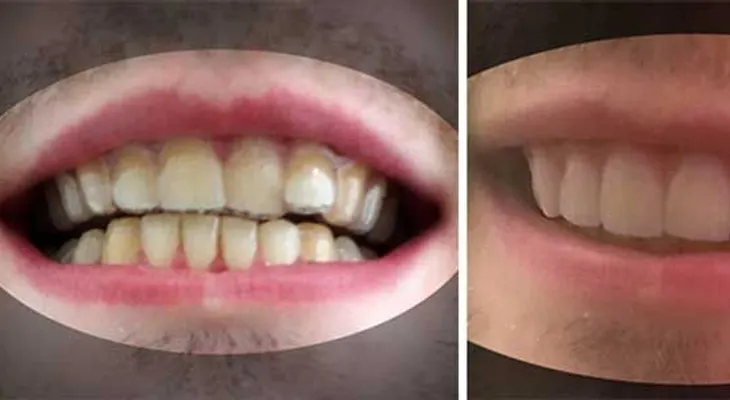 Estudiante diseña sus propios aparatos dentales por 60$ y se ahorra 8000$