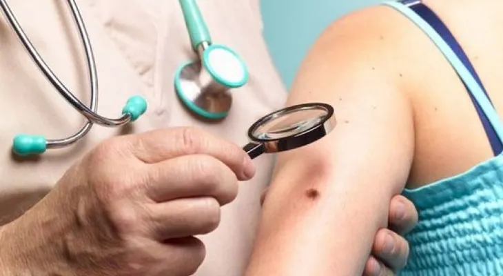 1 de cada 53 personas desarrollará melanoma a lo largo de su vida