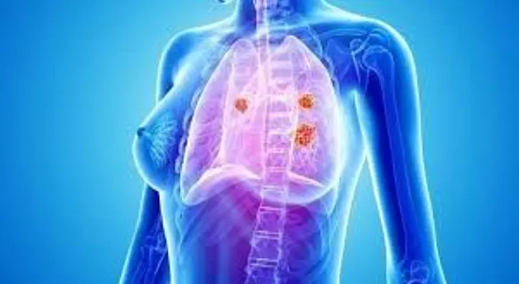 Desarrollan plataforma para detectar cáncer de mama con aliento