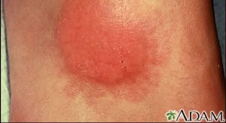 Granuloma anular, causas y síntomas