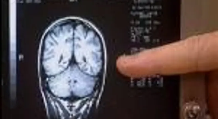Avance argentino para detección precoz del Parkinson.