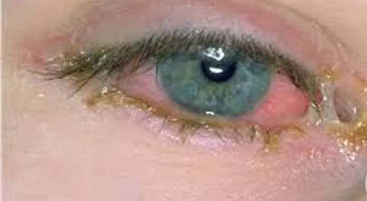 Más de 66 mil casos de conjuntivitis se han registrado en RD en lo que va de año