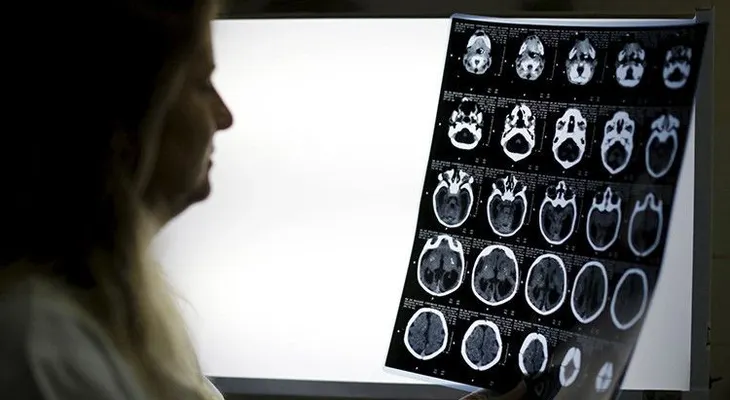 ?omer cerebros humanos protegió a una tribu de las enfermedades cerebrales