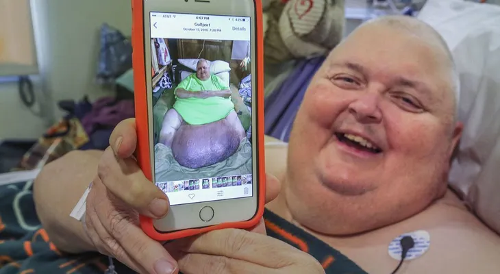"Estoy ansioso por comer tacos"; dice hombre que le sacaron un tumor de 59 kilos que nació de un vello encarnado