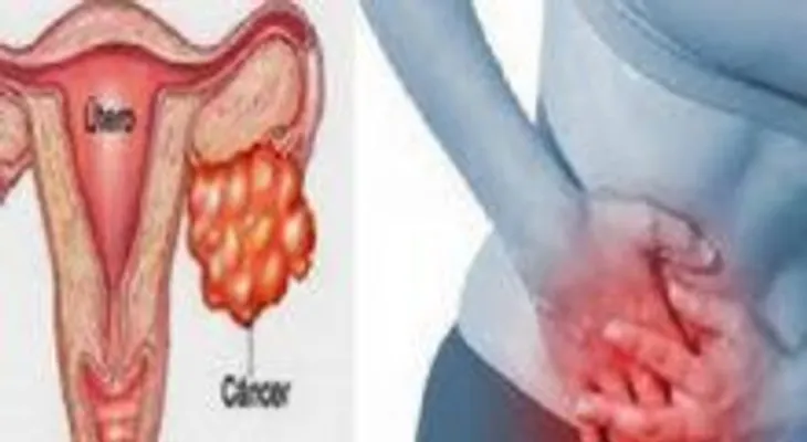 Este remedio ayudará a las mujeres a combatir el cáncer de ovario