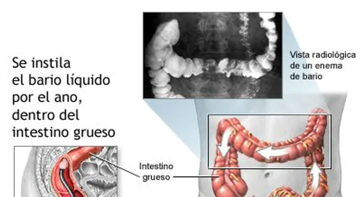Pólipos colorrectales; causas y síntomas
