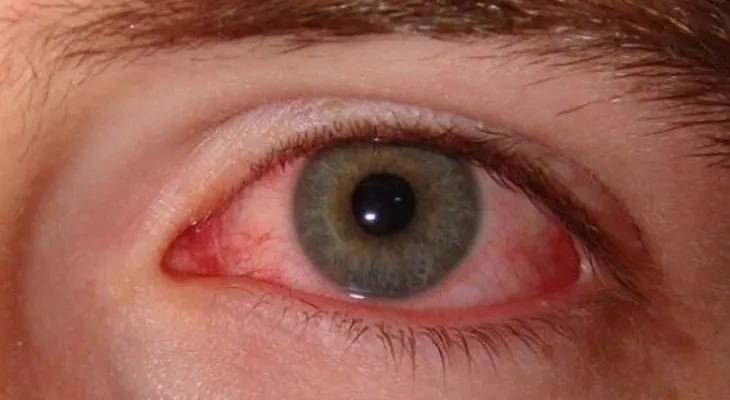 Si trabaja en una computadora descansa cada 20 minutos: Los ojos llorosos y cómo tratarlos 