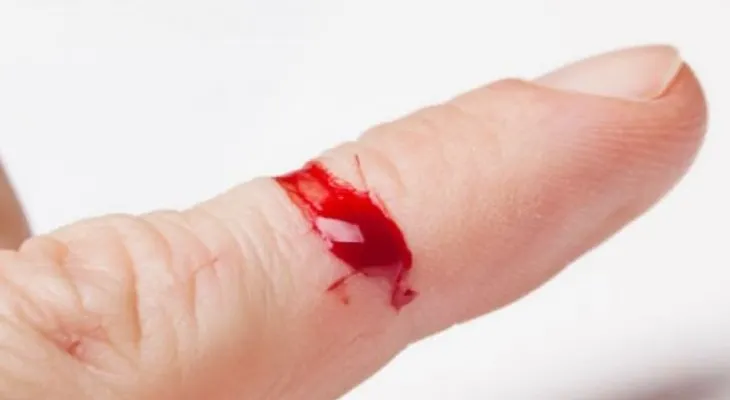 Daños articulares y hemorragias severas son padecidos por pacientes con hemofilia