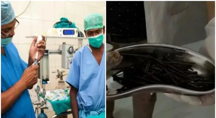 Médicos sacan 116 clavos del estómago de un hombre; duraron más de una hora para sacarlo