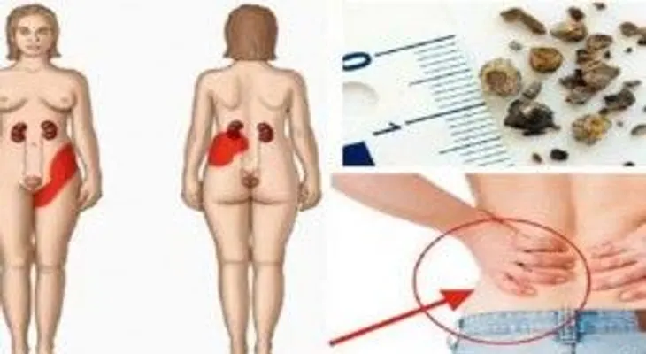5 síntomas y signos de cálculos renales