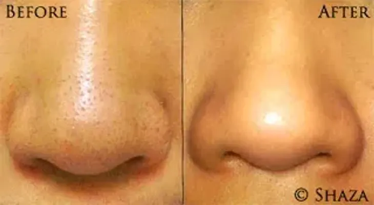 Elimina los puntos negros en menos de 10 minutos y solo necesitarás: 