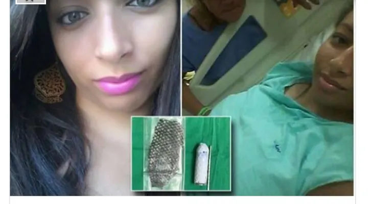 A una brasileña (Jucilene Marinho) le reconstruyen exitosamente la vagina con piel de pescado 