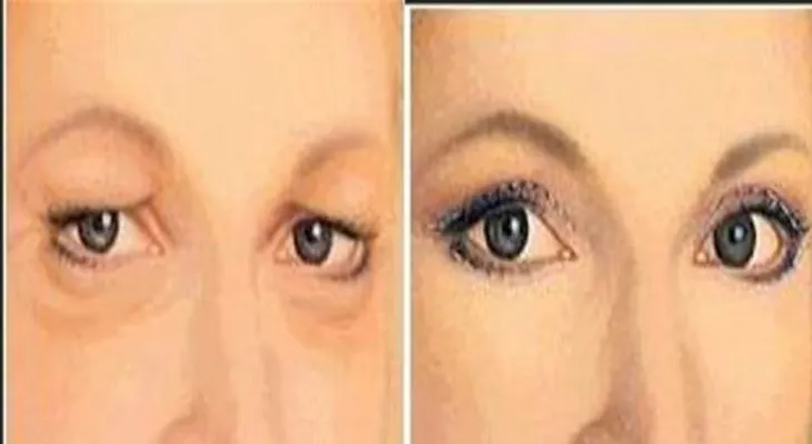 Reafirmar los párpado caído de forma natural con este remedio ¡es maravilloso!