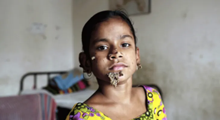 Operan con éxito a la "niña árbol" bangladesí