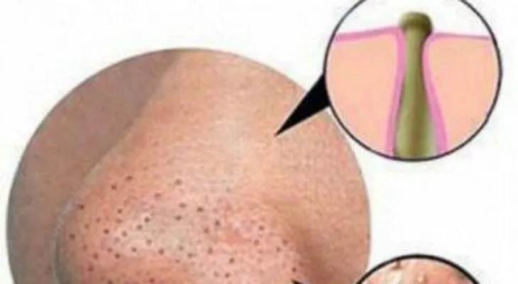 Receta para quitar los puntos negros de la cara
