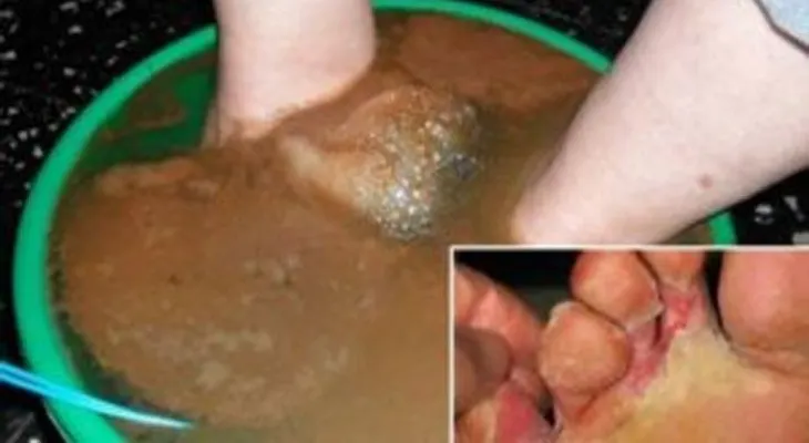 Mis pies se estaban pudriendo por un hongo y esta receta natural fue mi solución 