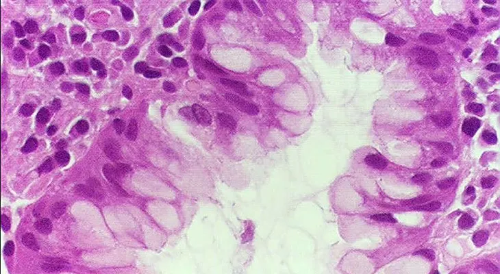 Una superbacteria mortífera que se propaga amenaza acabar el mundo 