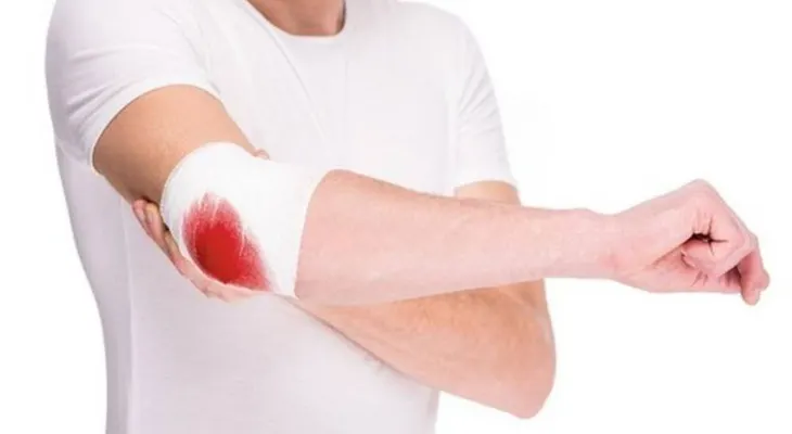 Tratamientos innovadores ayudan a evitar sangrados en pacientes con hemofilia