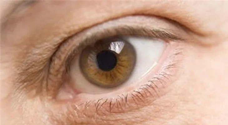 Piel seca alrededor de los ojos causas síntomas y tratamientos naturales