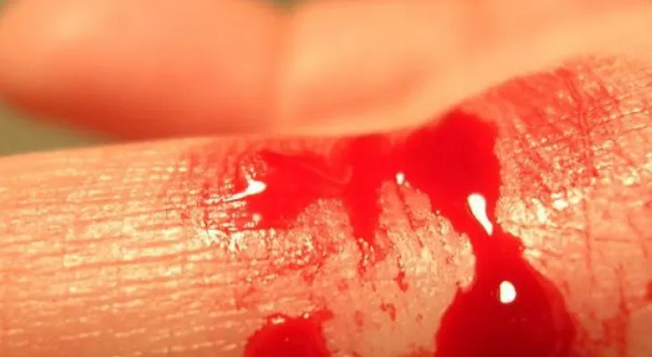 La hemofilia es una condición poco frecuente pero tiene altos riesgos