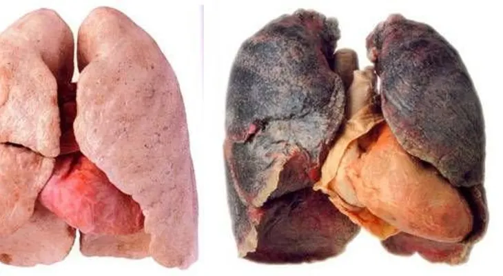 7 señales iniciales y síntomas del cáncer de pulmón, y como prevenirlo 