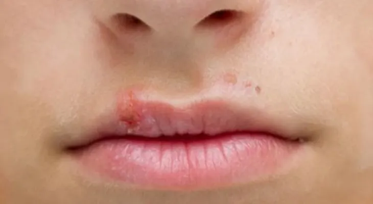 El molesto Herpes, todo lo que debes saber sobre él