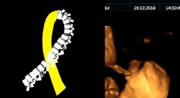 Médicos sacan bebé de seis meses del útero de la madre para curar su médula espinal, y lo vuelven a colocar