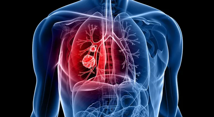  Un tratamiento triplica supervivencia en cáncer de pulmón no microcítico ALK+ 